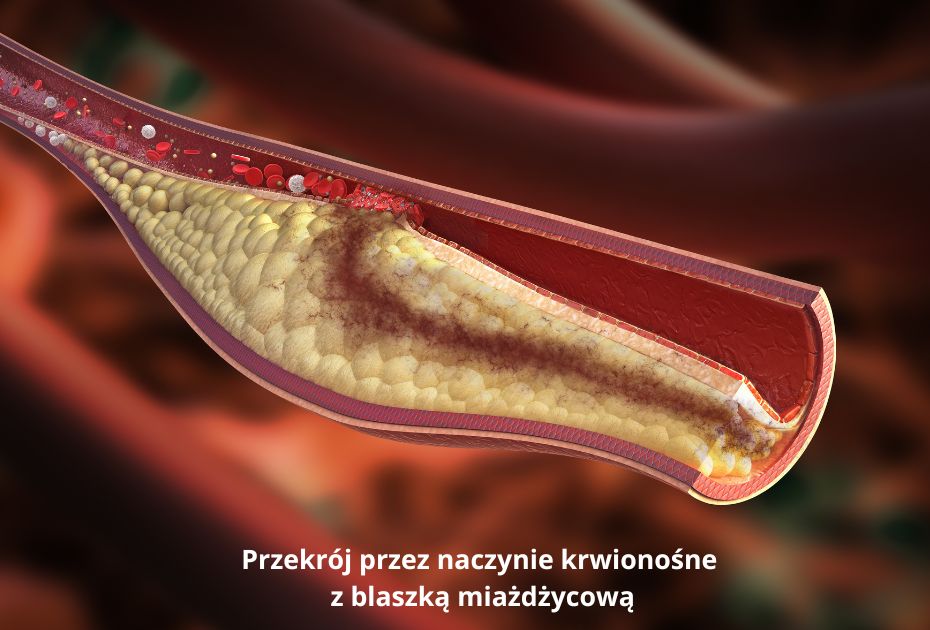 schemat naczynia krwionośnego z blaszką miażdżycową powstającą przy wysokim poziomie
utlenionego cholesterolu LDL we krwi